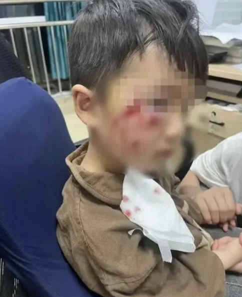 被疯犬咬伤没有“救命药”，怎么办？